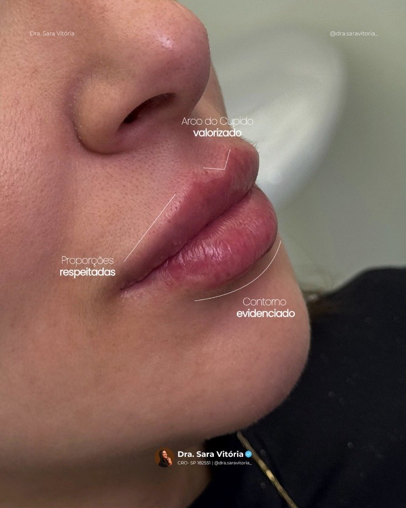 Resultado estético orofacial e contorno - Dra. Sara Vitória
